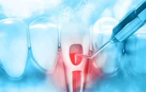 Laser Dentistry in Endodontic Treatments jpg