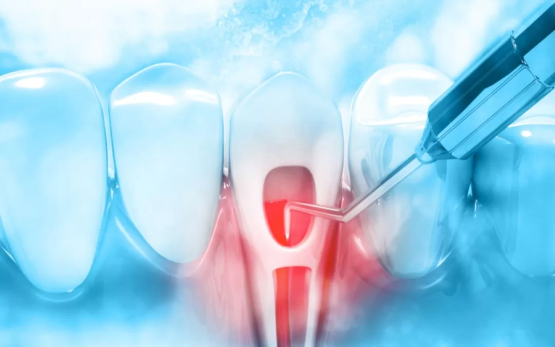 Lasers In Root Canal Treatment:Panacea