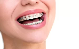 orthodontic smile 1910 1 1024x640 1