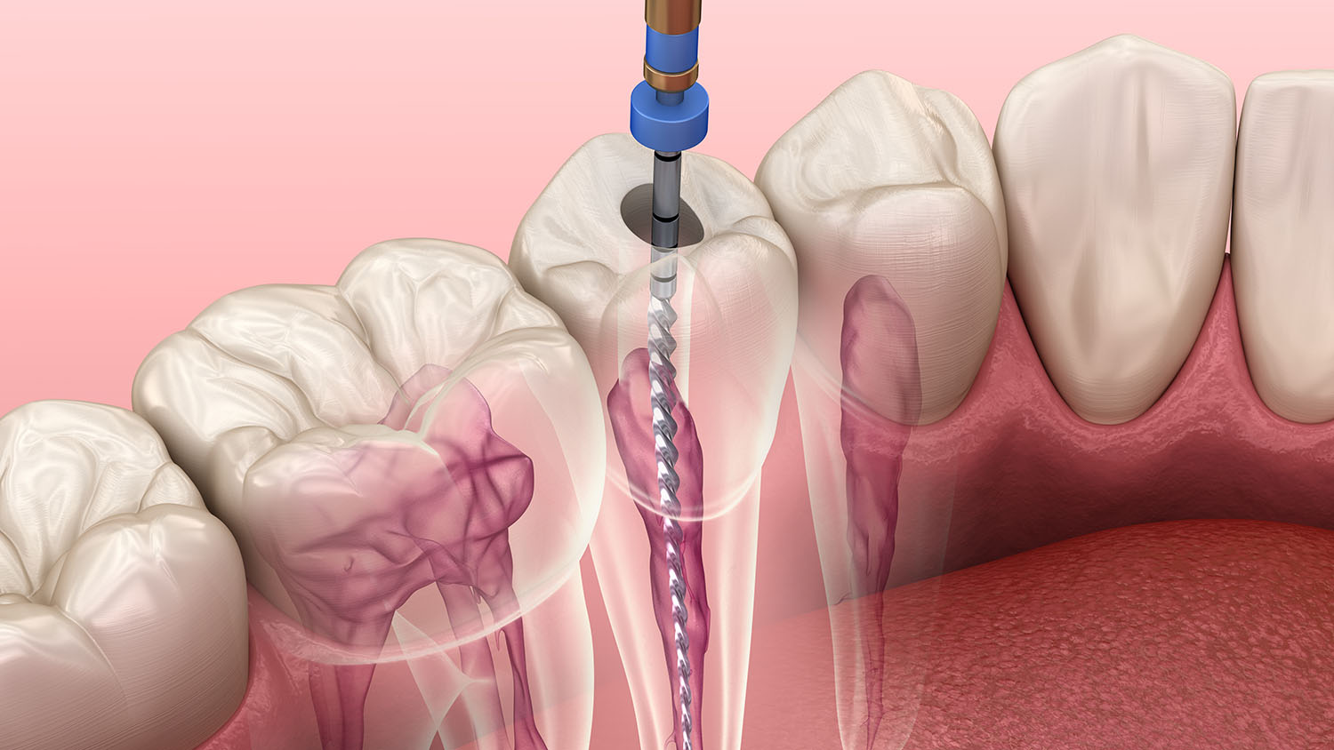 Root Canal Treatment in East of Kailash