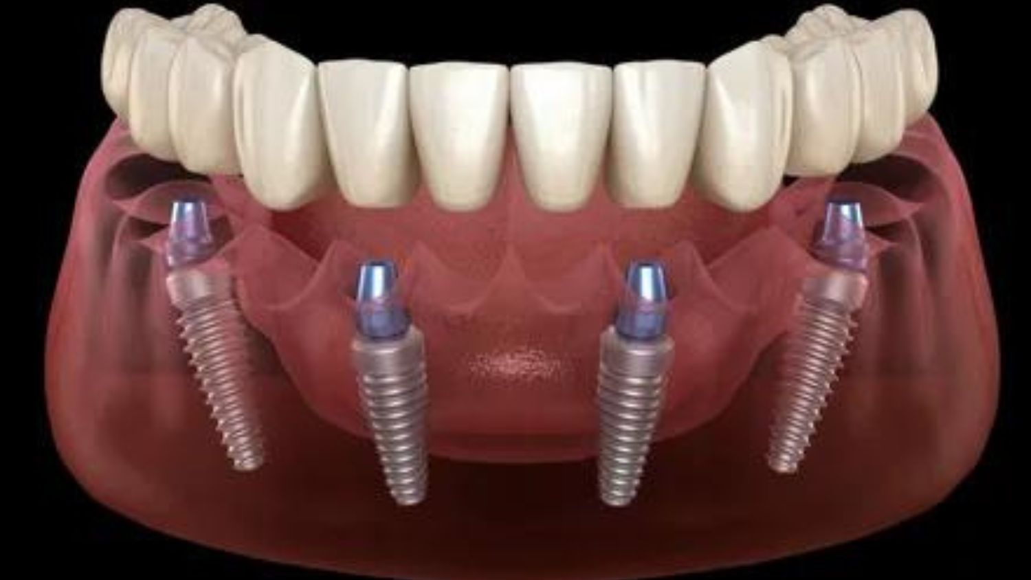 Dental Implant Treatment in South Delhi