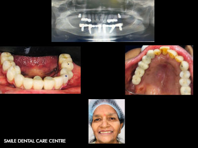 FRONT TOOTH IMPLANT