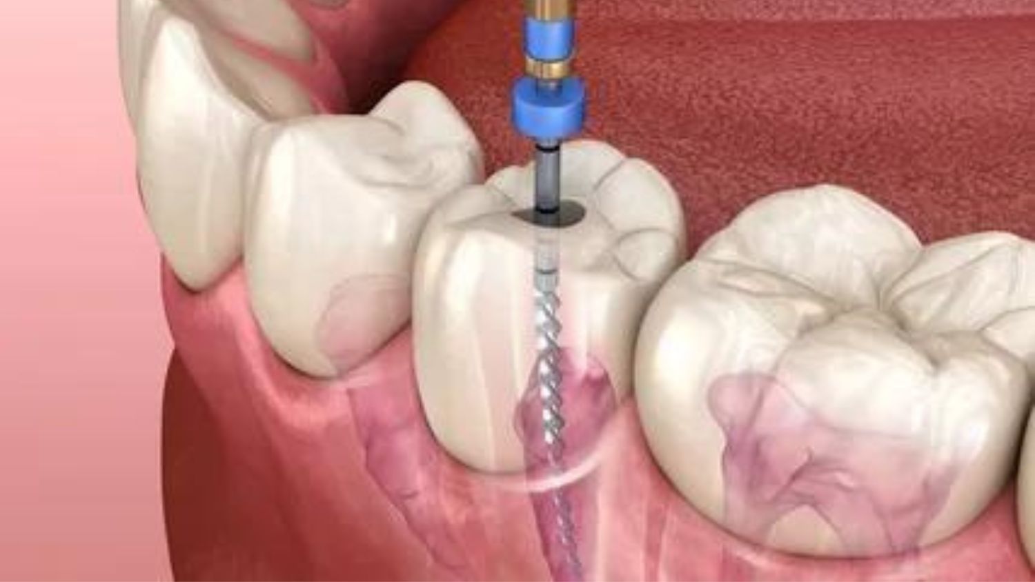 Root Canal Treatment in Faridabad
