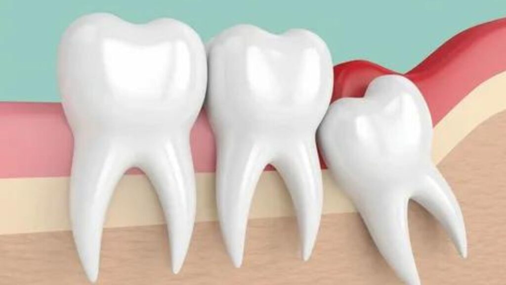 wisdom tooth removal in faridabad