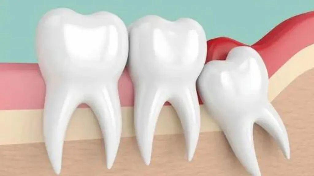 wisdom tooth removal in faridabad