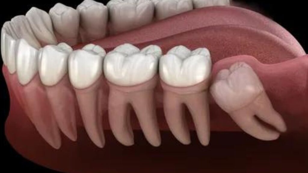 wisdom tooth removal in south delhi
