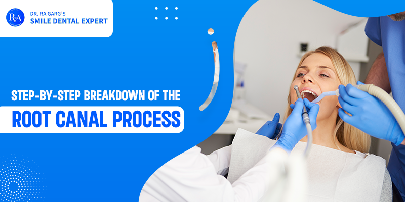 Step-by-Step Breakdown of the Root Canal Process