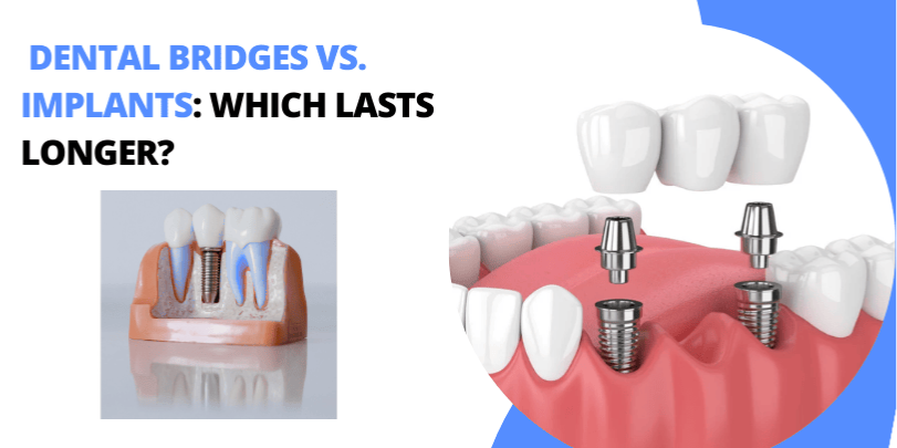Dental Bridges vs. Implants: Which Lasts Longer?