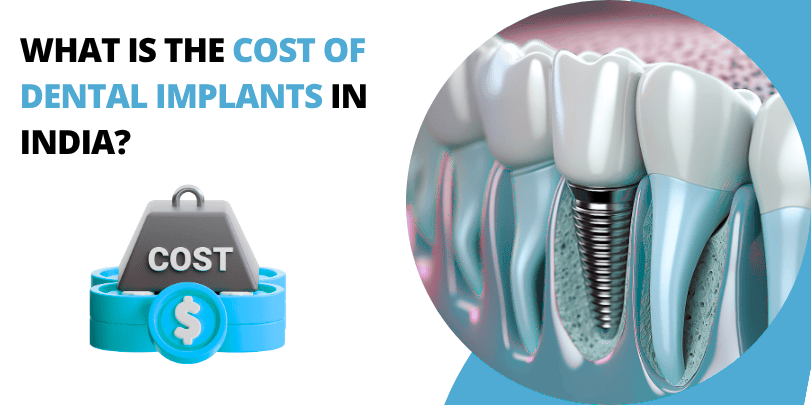 What Is the Cost of Dental Implants in India?