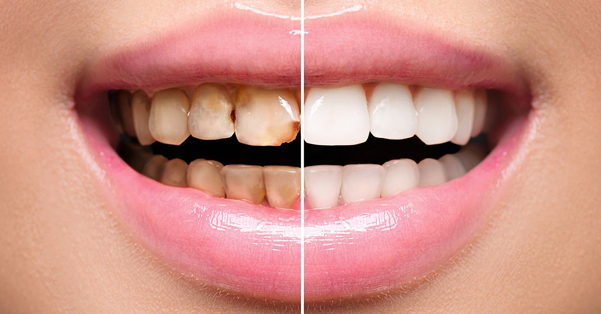 10 Clear Signs You’re an Ideal Candidate for Dental Veneers