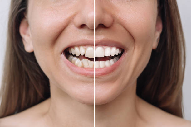Ceramic braces smile correction result