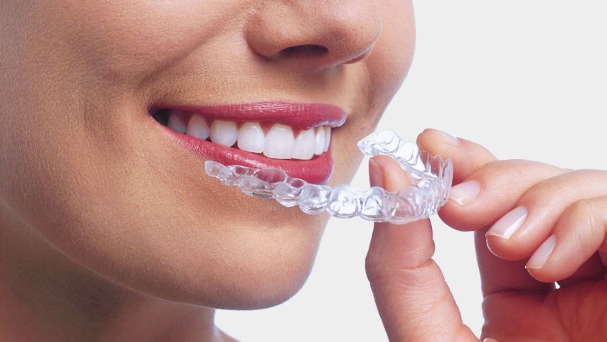 Invisible aligners treatment option