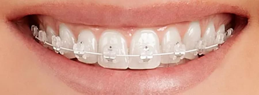 Specialist-led self-ligating braces treatment