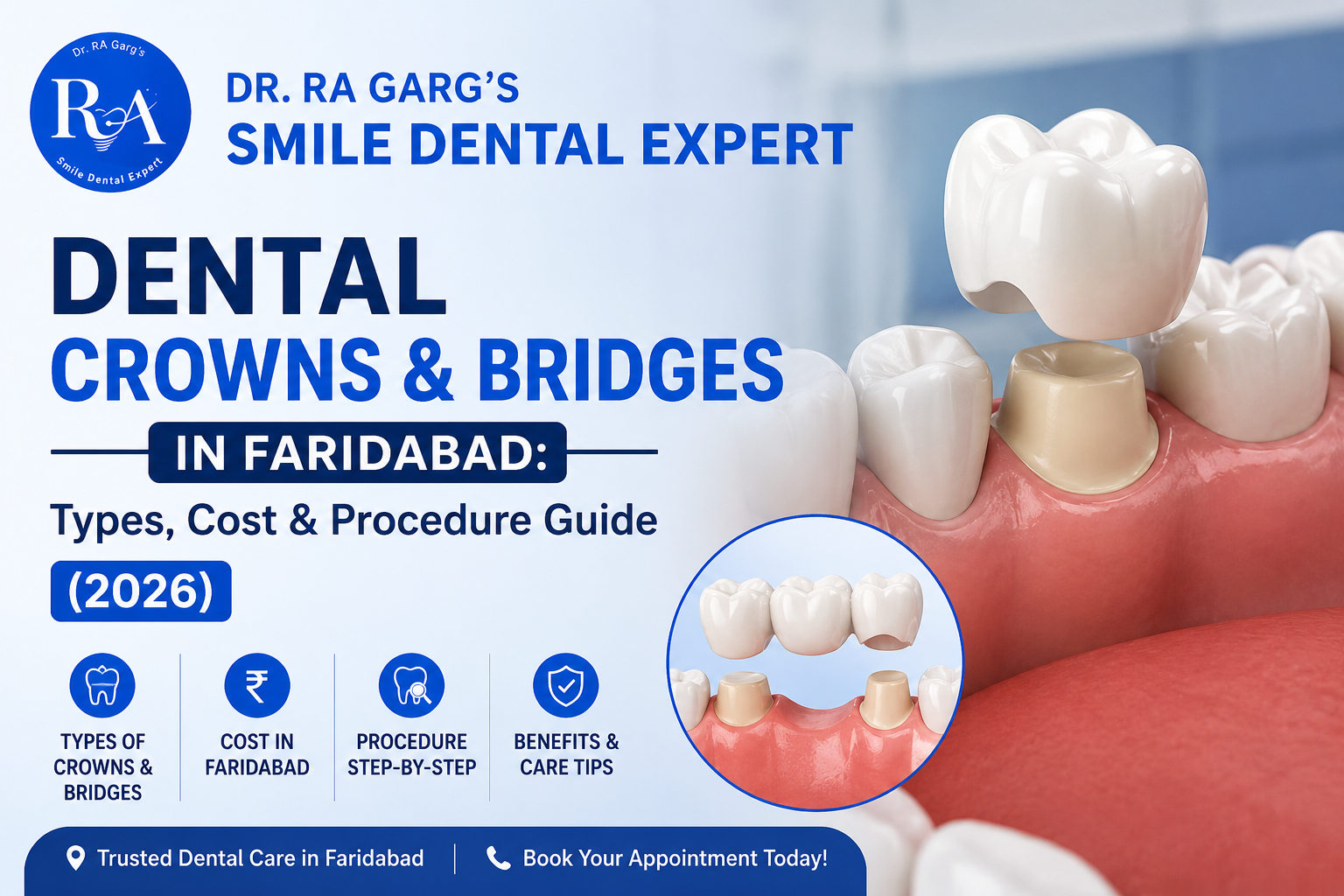 Dental Crowns and Bridges in Faridabad – Types, Cost and Procedure Guide 2026