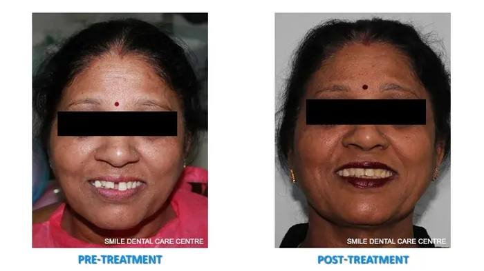Before and after adult orthodontics