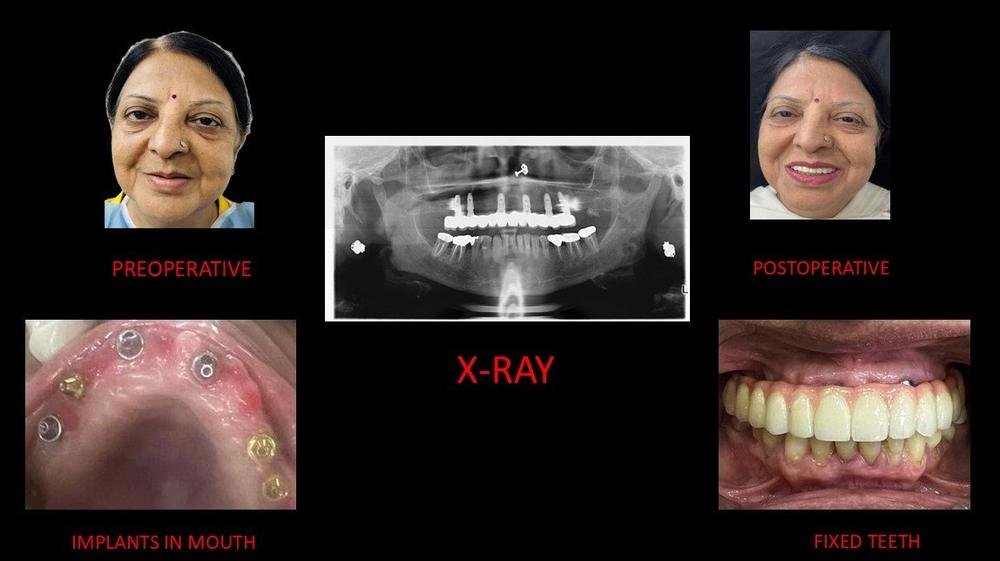 Full mouth implants - Before, X-ray and fixed teeth