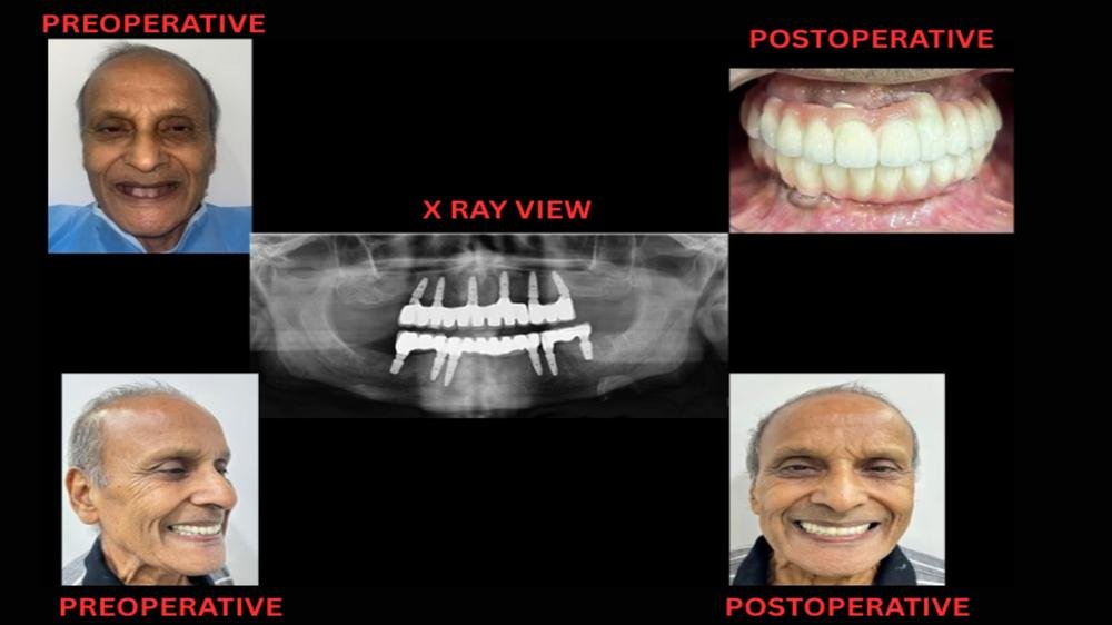 Full mouth implants - Fixed teeth on implants