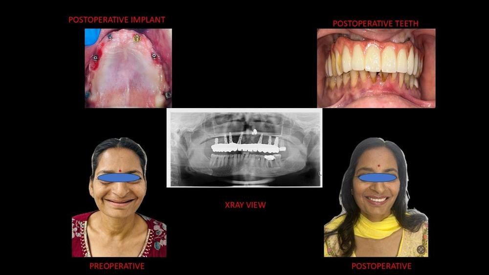 Upper & lower implants - Fixed teeth on implants