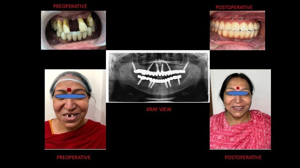 Full mouth implants - Before, X-ray and after
