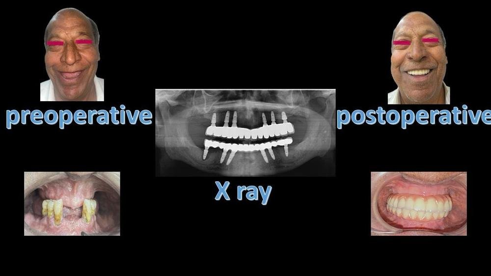 Full mouth implants - Before, X-ray and after