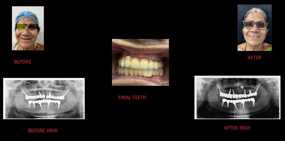 Implant-supported teeth - Before and after X-ray