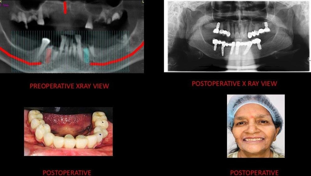 Full mouth rehabilitation - X-ray before and after