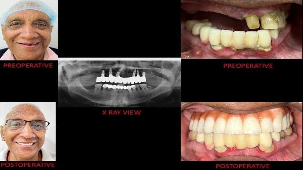 Full arch implants - Before, X-ray and after