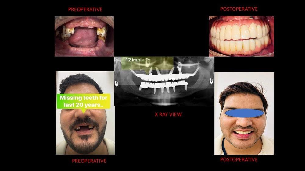Full mouth implant case of an international patient: before, X-ray and after