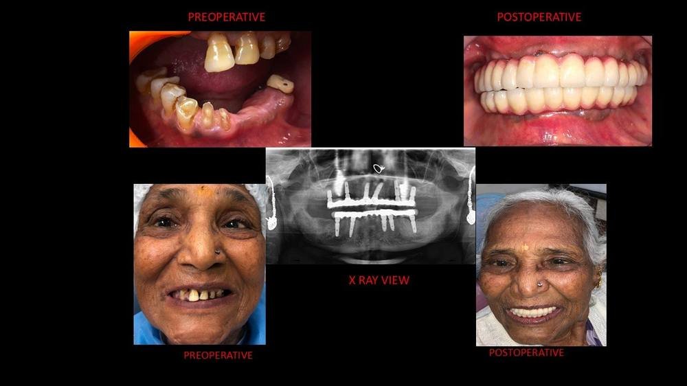 Full mouth implant case of a patient from Iraq: before, X-ray and after