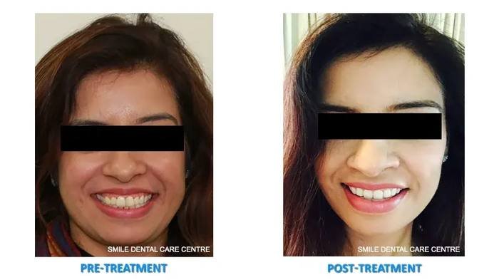 Before and after invisible braces