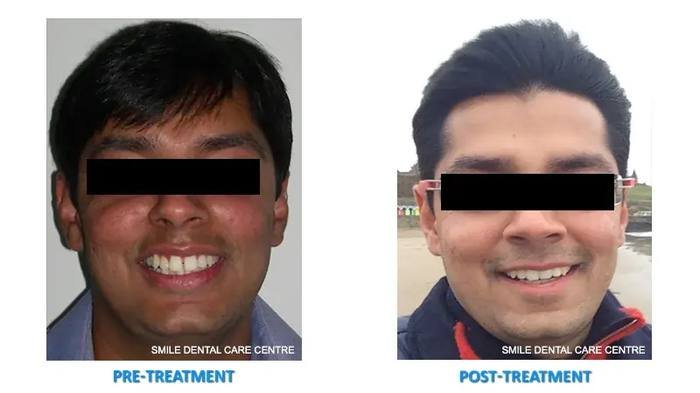 Before and after lingual braces