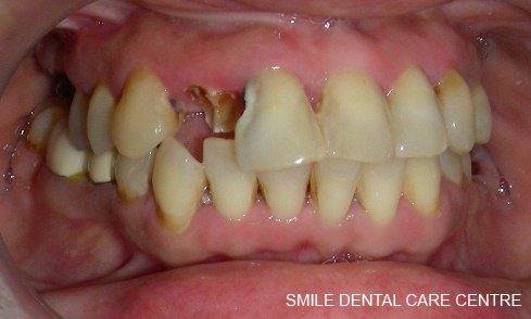 Smile makeover - Front teeth restored