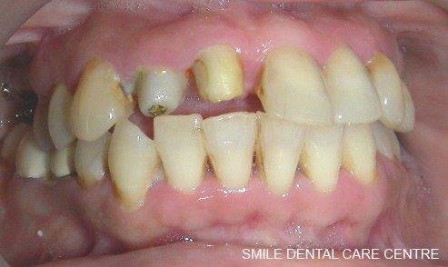Smile makeover - Gap and broken tooth fixed