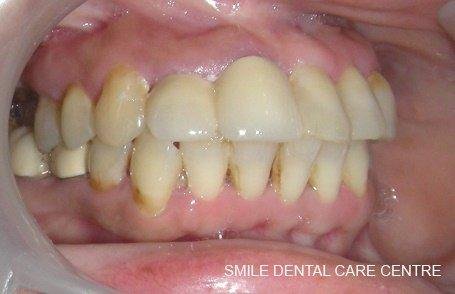 Crowns & bridge - Natural-looking front teeth