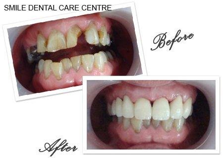Full smile restoration - Before and after