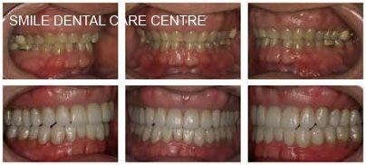 Smile rehabilitation - Step-by-step result